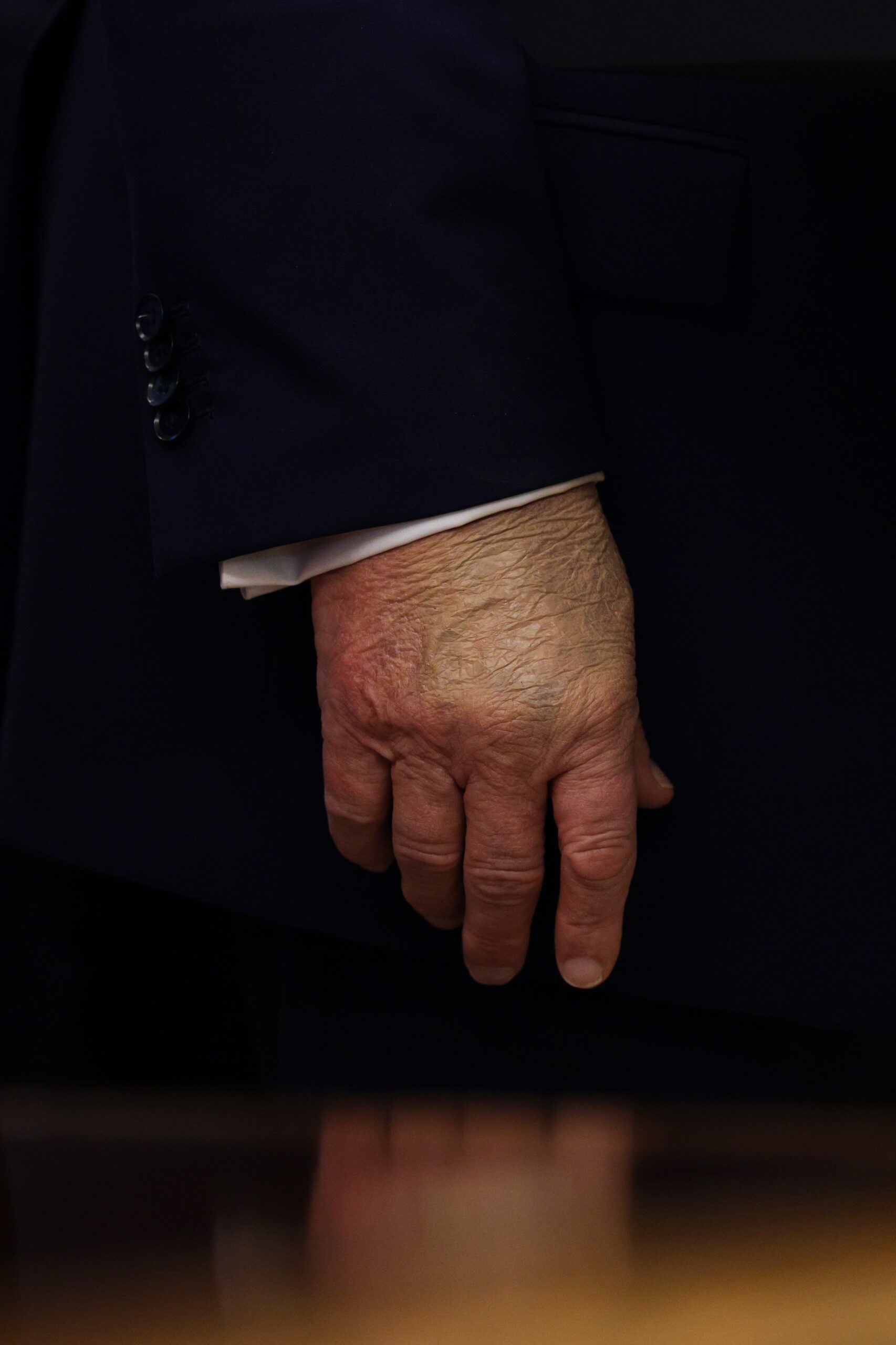 Donald Trump Has Bruised Hand In New Conference